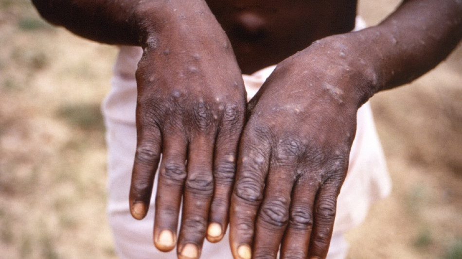 No concern yet monkeypox will cause pandemic: WHO